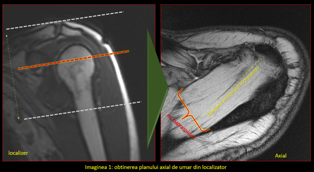 RMN (Rezonanta Magnetica) - mana, picior, glezna, genunchi, cot